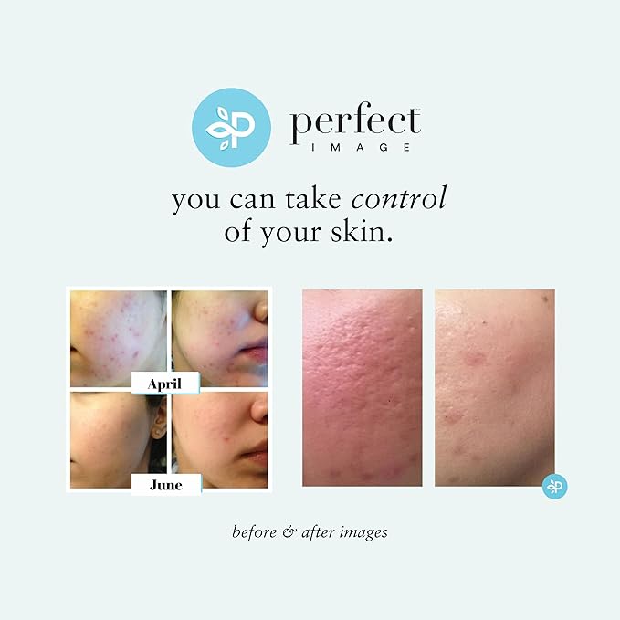 Lactic 50% Gel Peel, Chemical Peels for Face Breakout Scars, Chemical Exfoliant for Face, Strength Level 2, 1.0 fl oz. e, 30 mL – Perfect Image